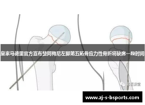 皇家马德里官方宣布楚阿梅尼左脚第五跖骨应力性骨折将缺席一段时间 皇家马德里官方宣布楚阿梅尼左脚第五跖骨应力性骨折将缺席一段时间
